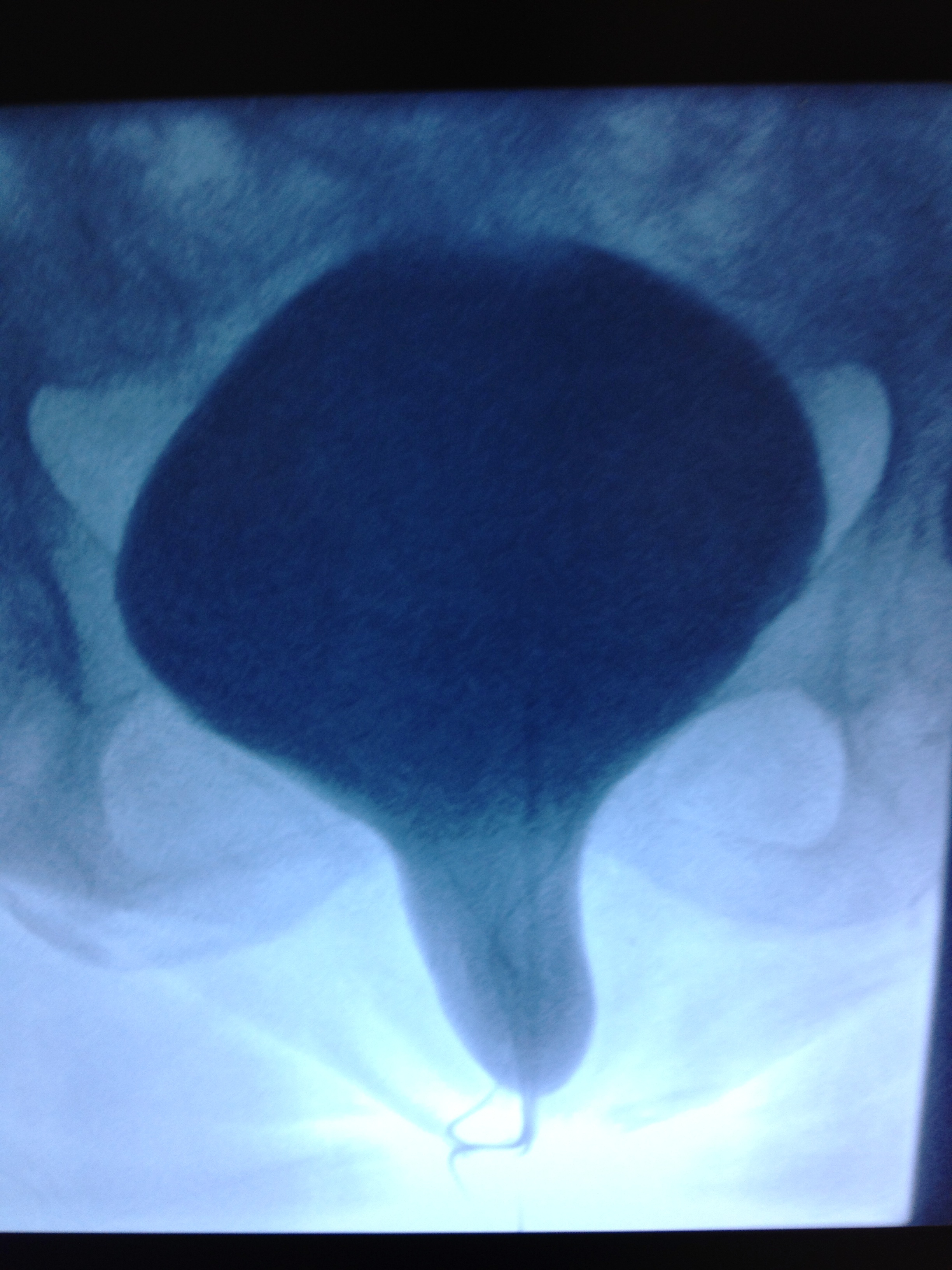 Cystogram Cystocele Grade Three